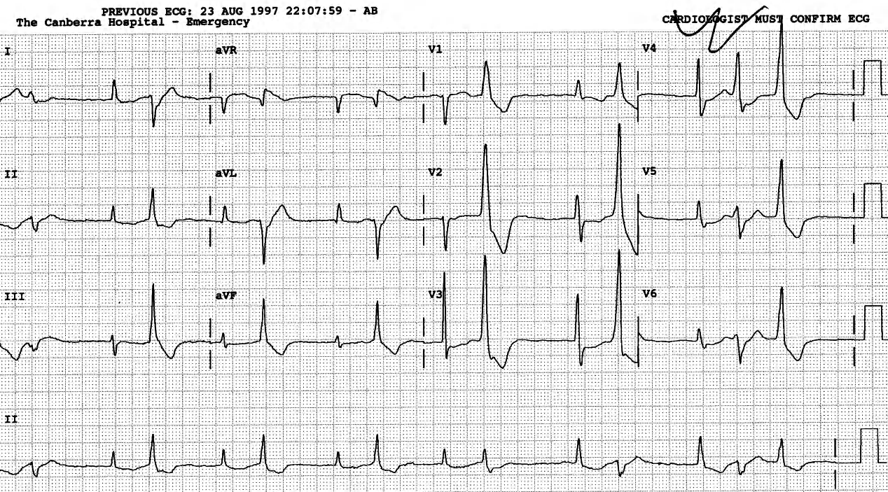 91 year old lady on chronic digoxin therapy, with falling potassium and rising creatinine levels. 