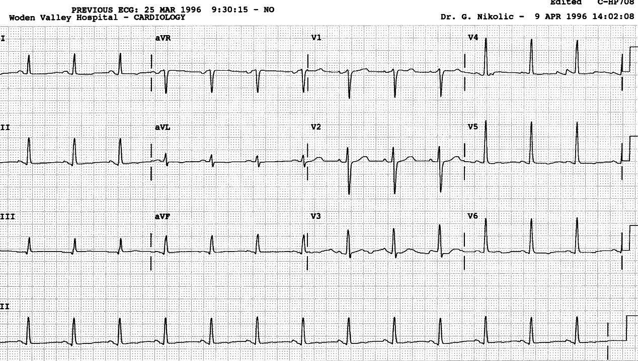 PR segments unchanged, but pericarditis all the same.