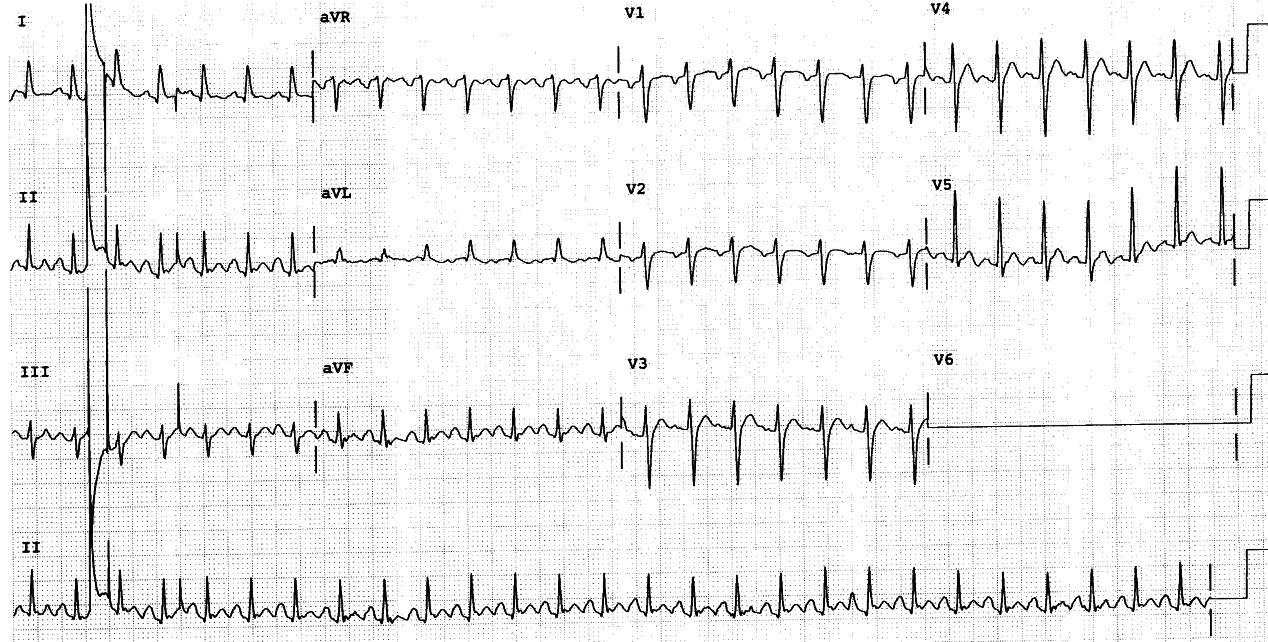 60 year old manic-depressive woman with gross agitation who became stuporose on lithium therapy over two days.