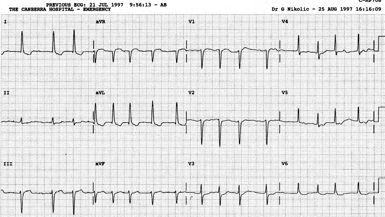 AF, LVH with ST/T changes, perhaps some digoxin effect. The latter would not be routinely reported. 