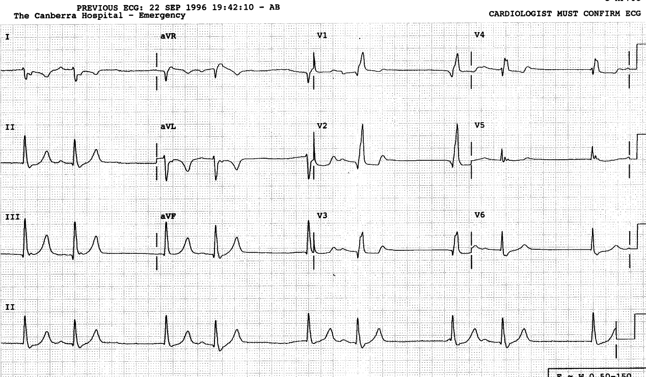 21 year old lady with recurrent tachycardias following remote repair of tetralogy of Fallot, soon after cardioversion with IV sotalol. The seventh QRS complex is preceded by a bump. What is it? Why is the next PR interval longer than others?