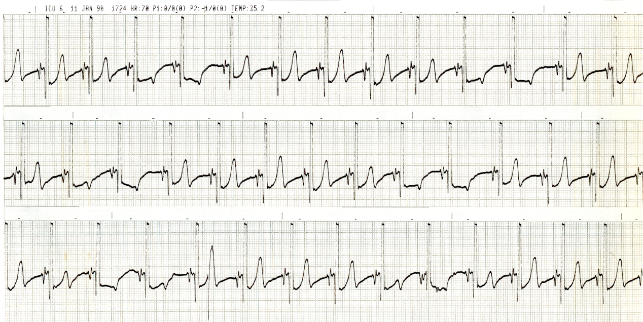 29 year old woman with hypokalÃ¦mia, hypercalcÃ¦mia and hypermagnesÃ¦mia due to near-drowning. Explain the phasic reversal of her T wave polarity