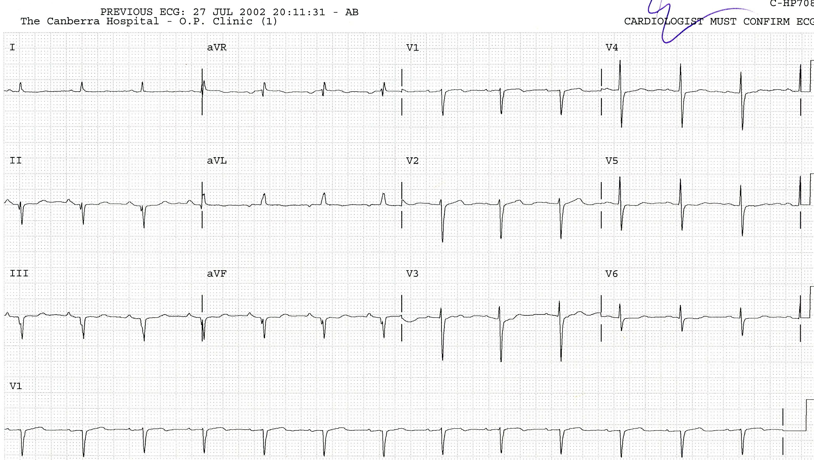 76 year old man admitted for removal of a meningioma. He has history of remote myovcardial infarction.