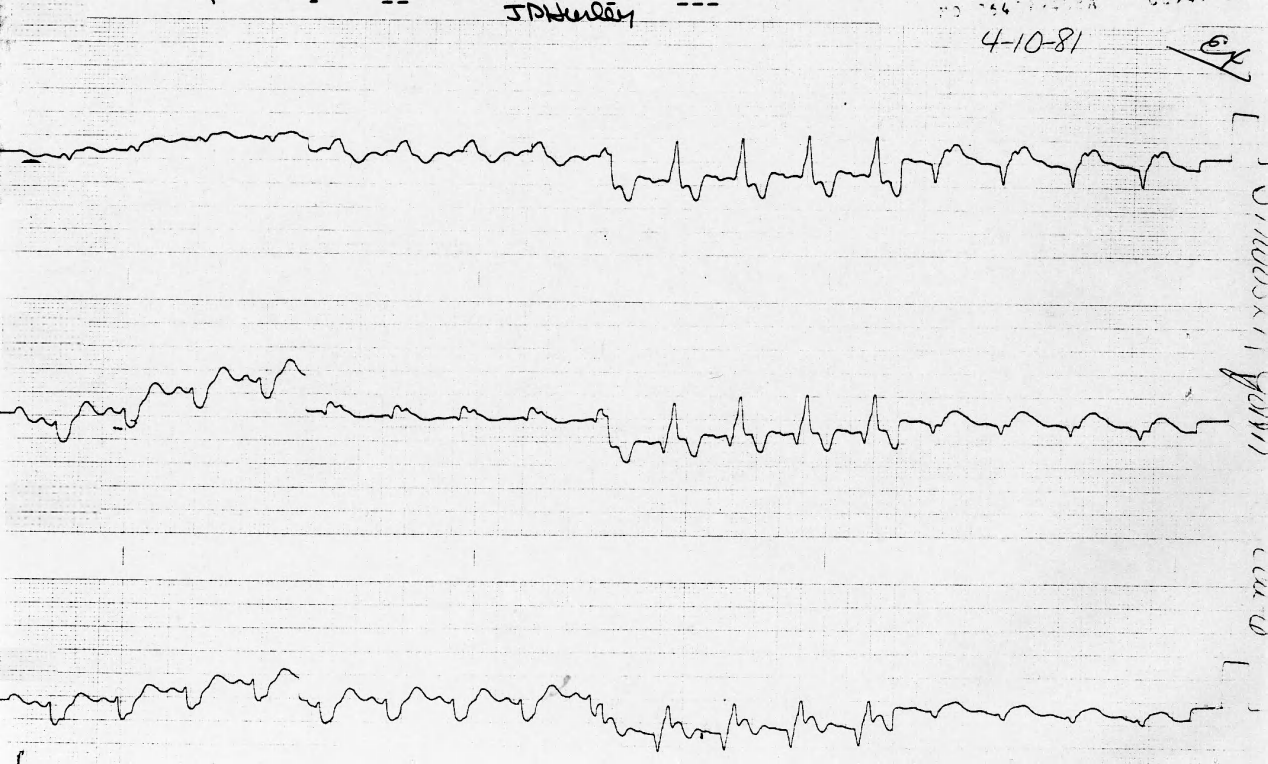 Definite sinus P waves. 