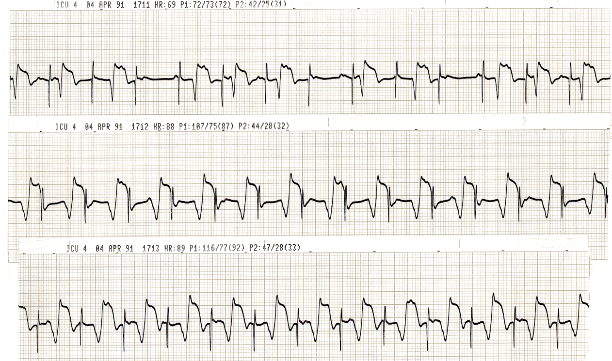 Temporary AV sequential pacing, several hours later. Not a great idea with PAT with block. There is no evidence of atrial capture in the top strip; there may be occasional one in the lower strips, hÃ¦modynamically worthless. Right ventricular pacing in the two lower strips did improve the cardiac output through increased heart rate without concomittant rise in pulmonary pressure. 