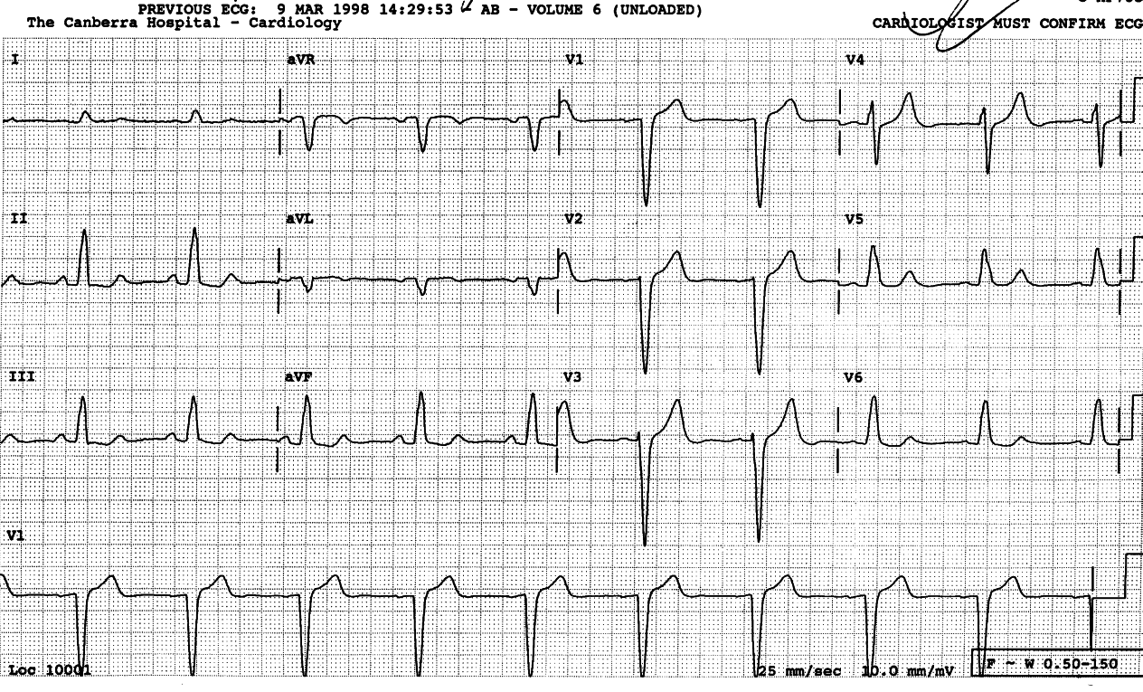 Pre-stroke ECG.