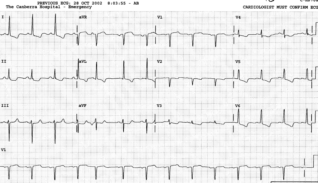 The junctional SVEBâs Pâ is invisible in the V1 rhythm strip but quite obviopus in lead aVF and above.