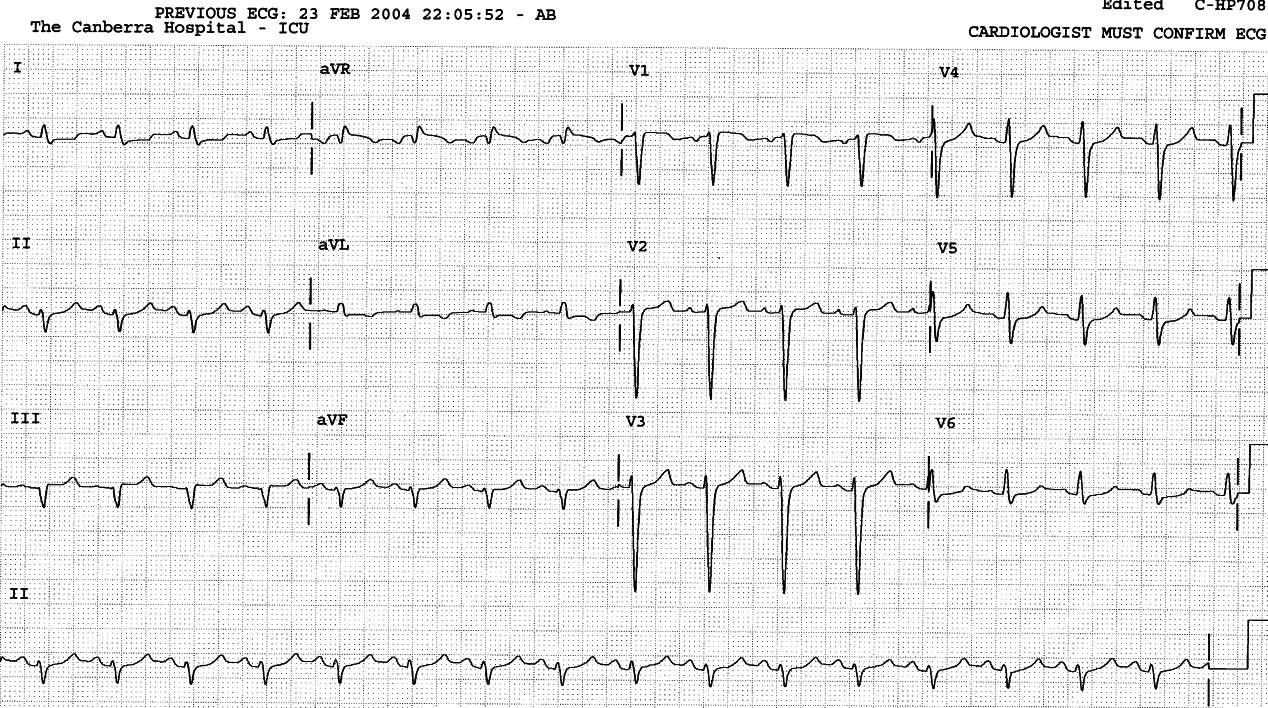 The QRS duration and T waves have normalised, but LAHB and ST segment depression denote probable myocardial disease.