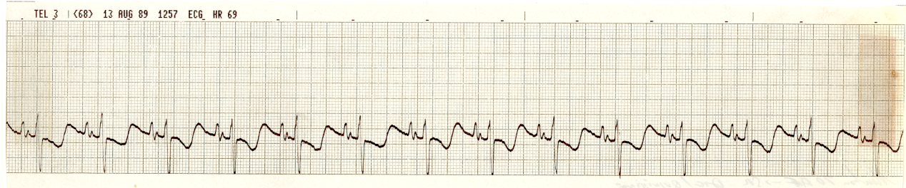 Digoxin + quinidine mime of hypokalÃ¦mia.