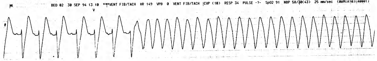 Left bundle branch block and broad complex tachycardia (lead V1) in 67 year old woman with DVT complicating surgery for meningioma. What is the significance of R-on-T phenomenon in this case? 