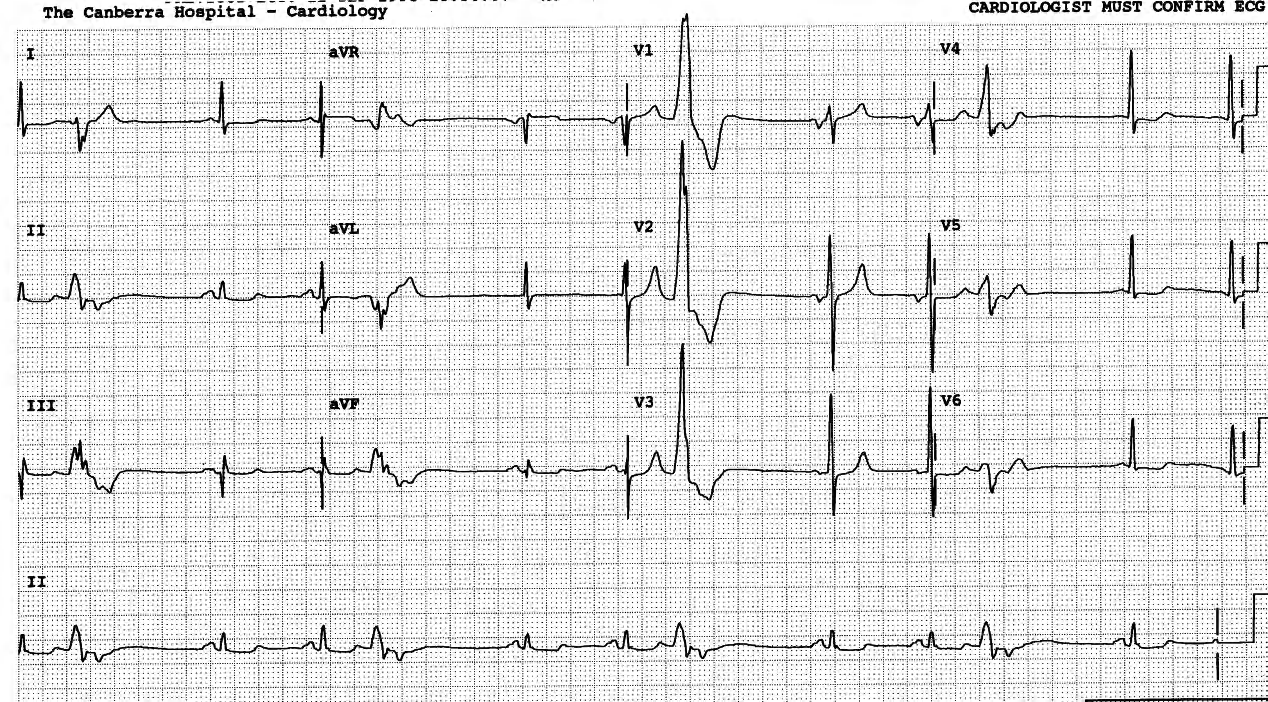 56 year old man with COAD and severe angina pectoris. 