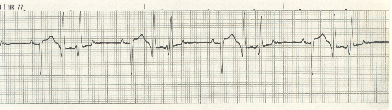 Trigeminy. Two P waves are blocked by each VEB couplet, but only one is visible. 