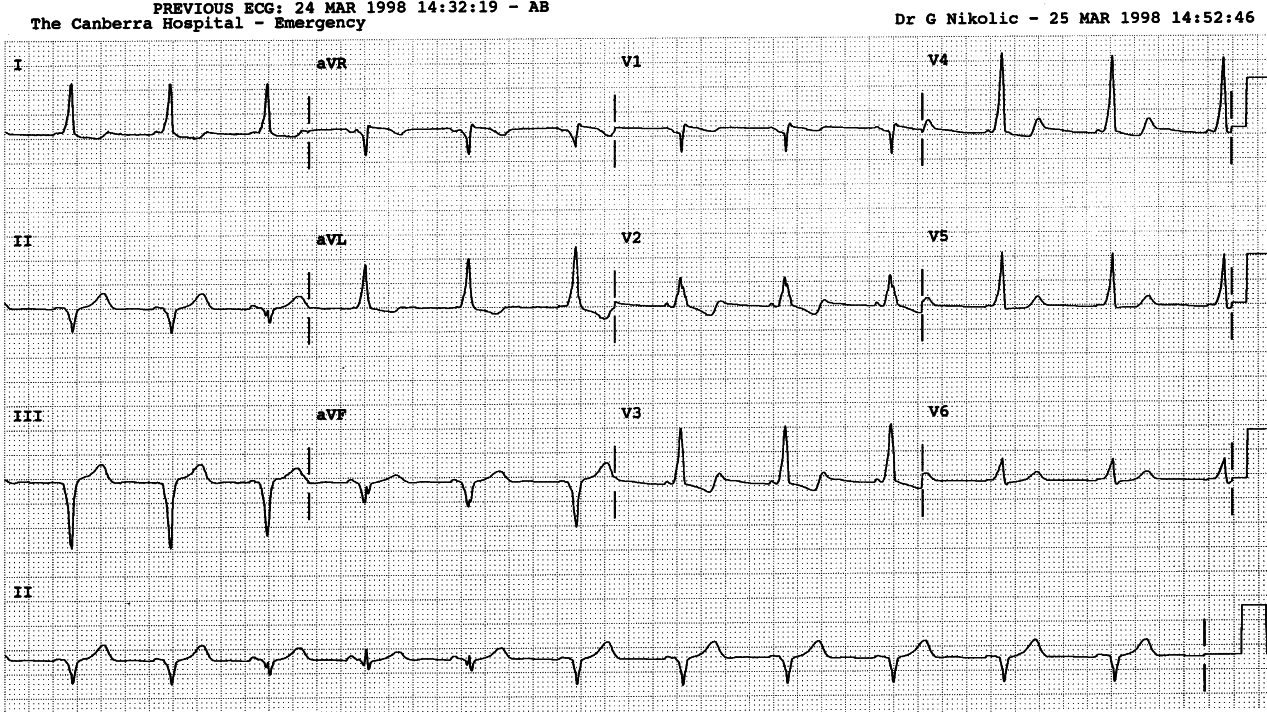 27 year old lady with long history of rapid palpitations.