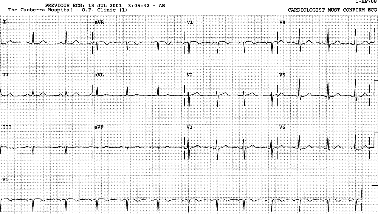 Normalised ECG.