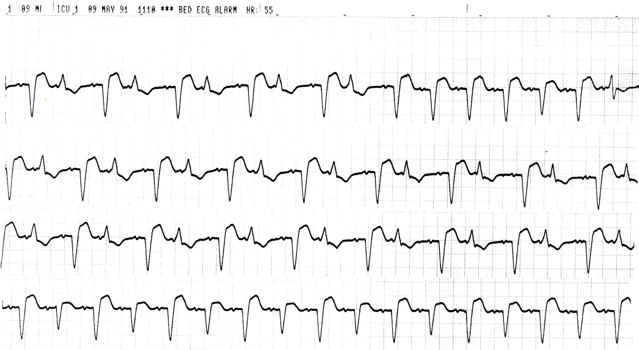 68 year old woman with HÃ¦mophilus influenzÃ¦ pneumonia. What is the cause of the apparent alternans in the bottom strip? Is it an alternans in the first place?