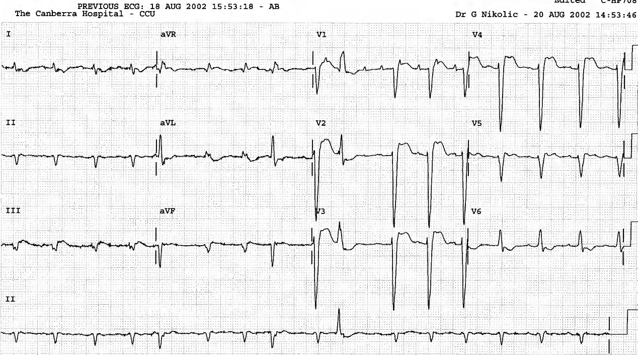 A readmission ECG in PAT with block. The P waves are typically best seen (and counted) in V1. 