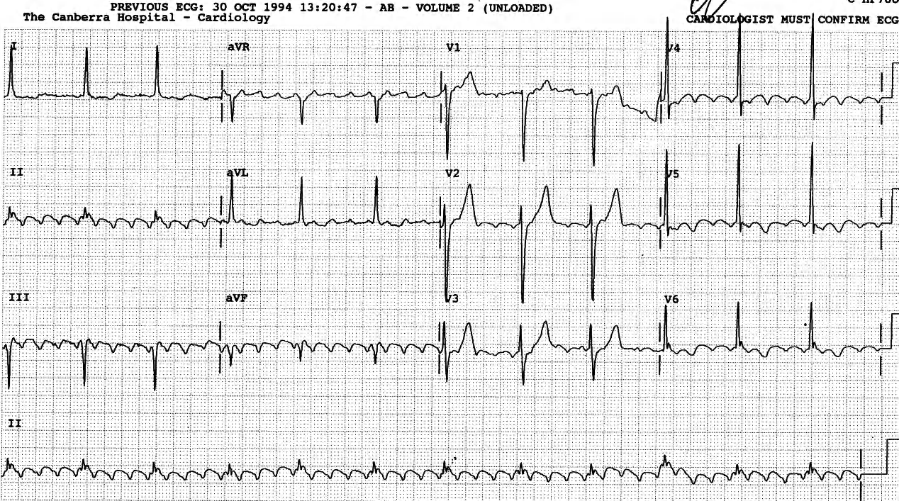 Atrial flutter 280/min with 4:1 block. 