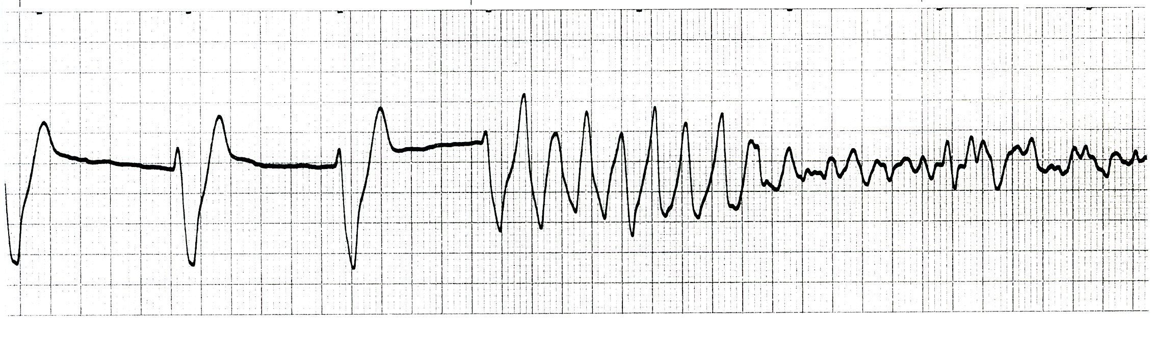 Real R-on-T and subsequent VF. 