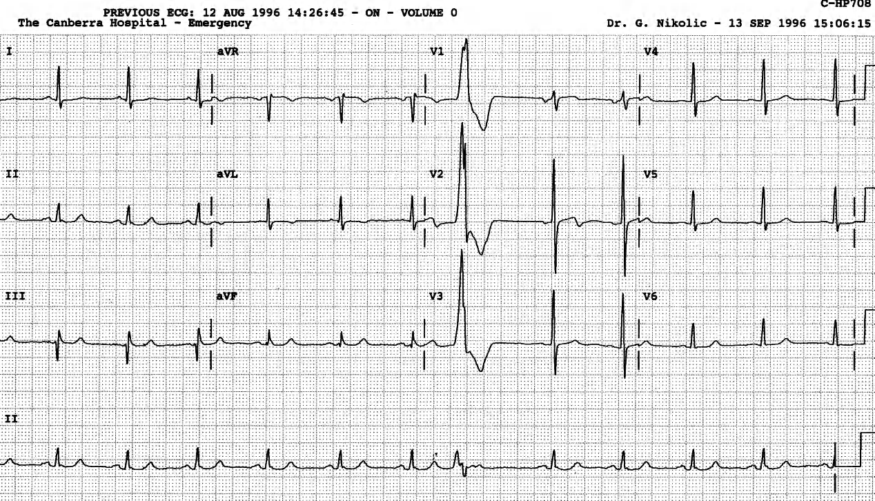 The VEBâs retrograde conduction is blocked â the visible sinus P wave â also blocked â has beaten it to it. There is a compensatory pause. 