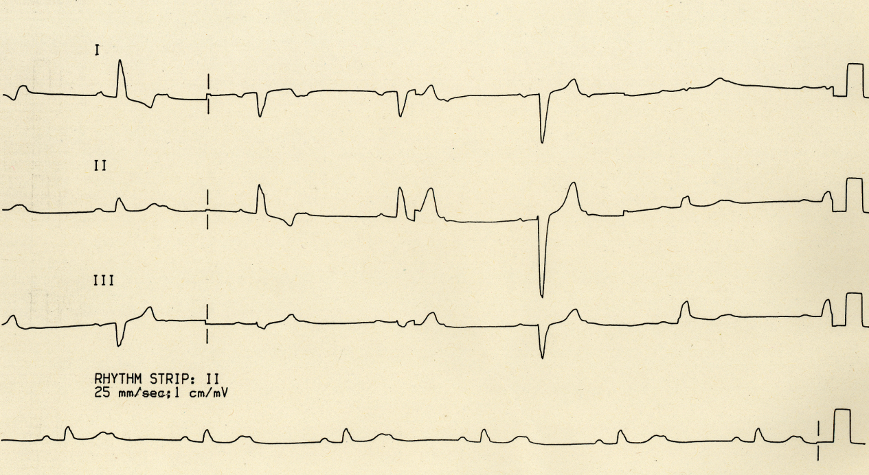 60 year old woman who became breathless and light-headed during a holiday on Norfolk Island. She had an episode of myocarditis 25 years ago. 