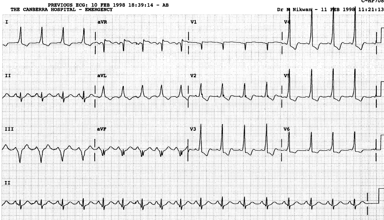 Same patient. The PR segment is more distinct, but still an illusion (vertical line through leads 1, 2 and 3 shows the onset of the QRS complex). Lead 2 is unsatisfactory for ventricular conduction (and so is, by clang association, V2 in this trace).