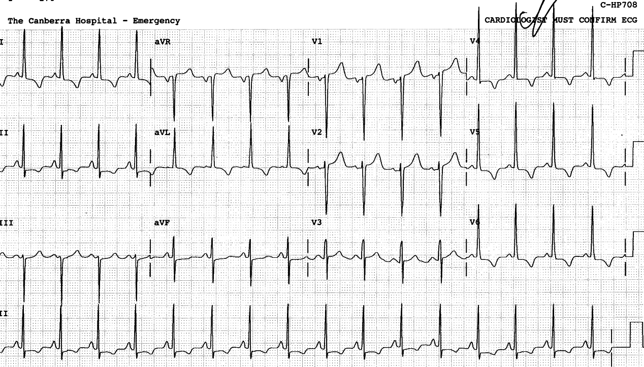 47 year old man found to have BP 220/140 mmHg by his local doctor