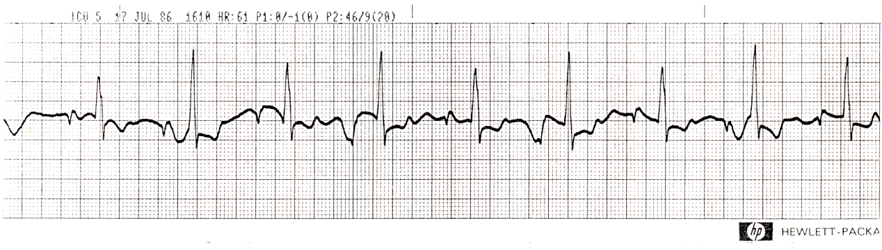 Pseudoalternans due to tachypnÅa.