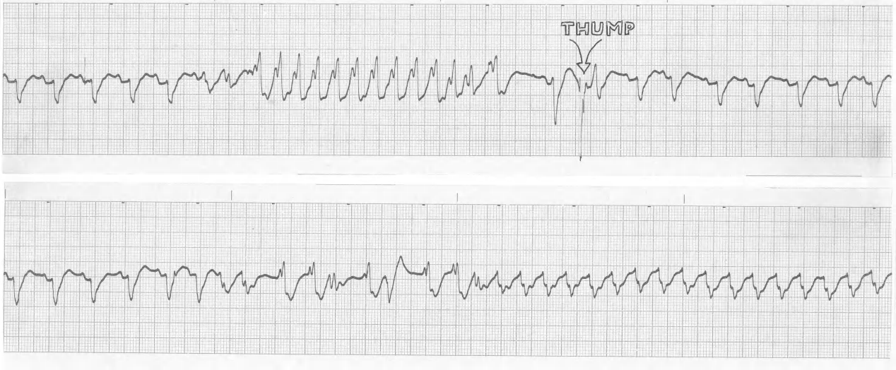 Recurrent VT in a 70 year old man with peritonitis and septic shock. The Intensivist is demonstrating thump cardioversion. What is the likely age of the Intensivist? 