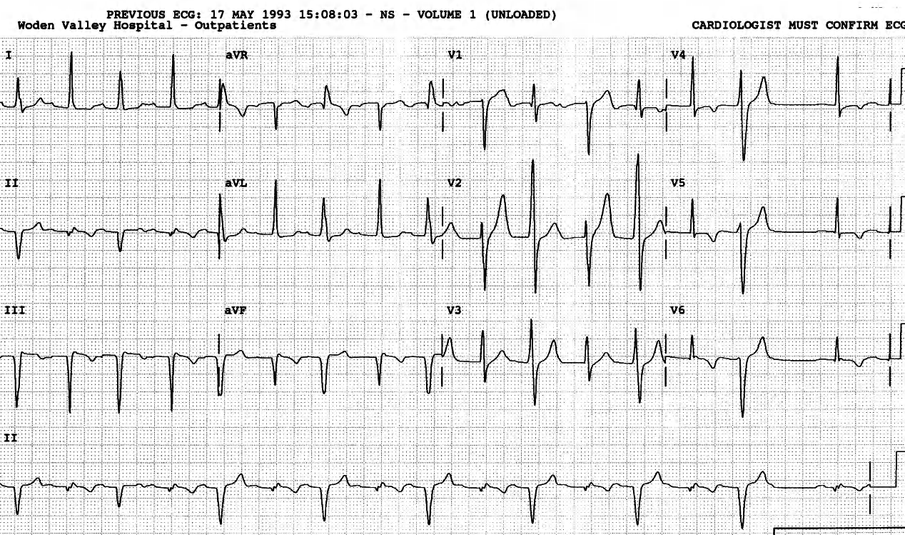 Outpatient ECG in an 82 year old man with history of cardiac irregularity. 