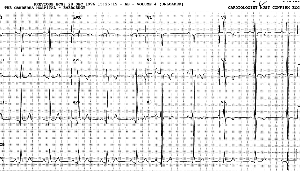 Clubbed and cyanosed 41 year old survivor of congenital disease described as âa variant of single ventricleâ