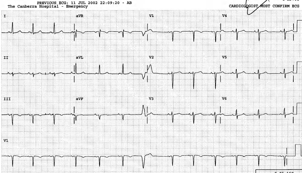 The VEBâs retrograde conduction has reset the SA node. 