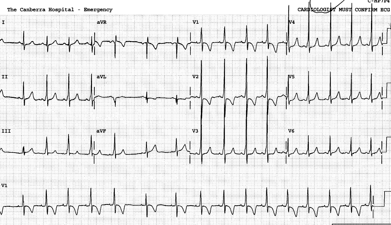 WPW âAâ in another patient, with intermittent anomalous conduction favoured by the fast phase of sinus arrhythmia. Again, what looks like a normal PR interval in lead 1 is refuted by the synchronous leads 2 and 3 below.