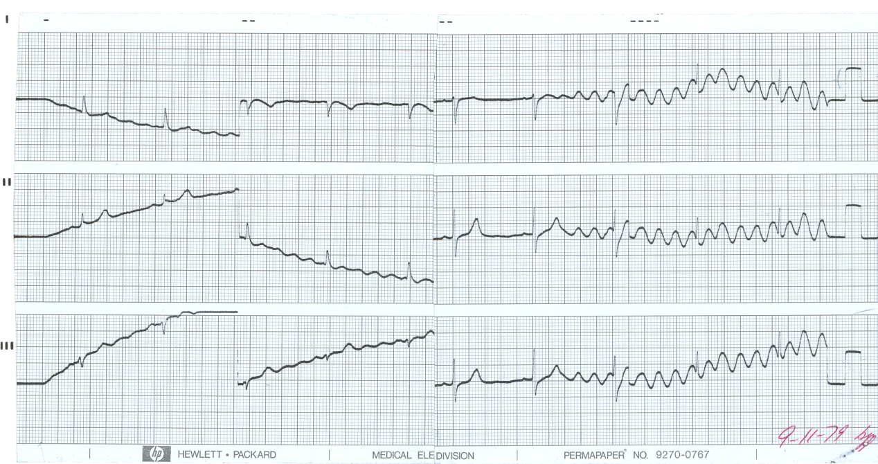 A Neurology outpatient with no cardiac history, sign or symptoms