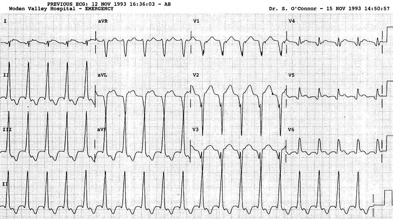 80 year old lady with chest pain and sudden drop in blood pressure. 