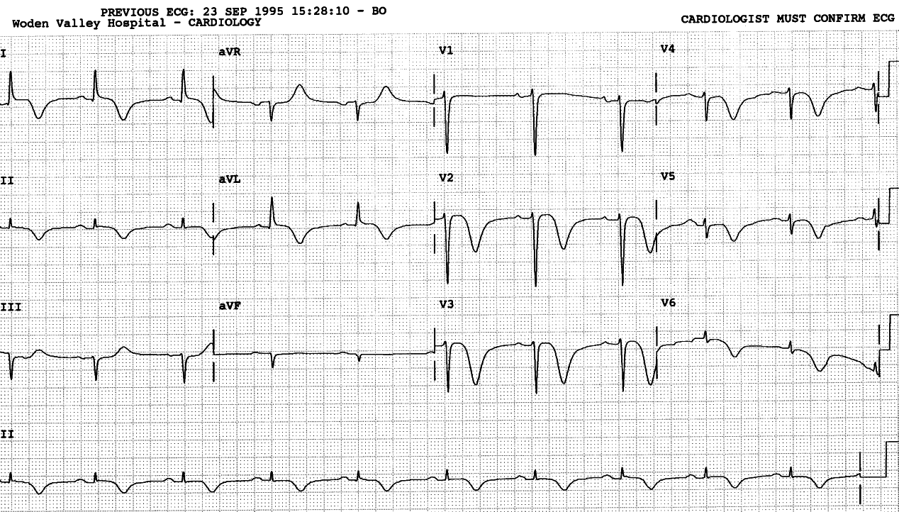 65 year old lady with atypical chest pains, which resolved on admission. She then developed the ECG changes shown below.