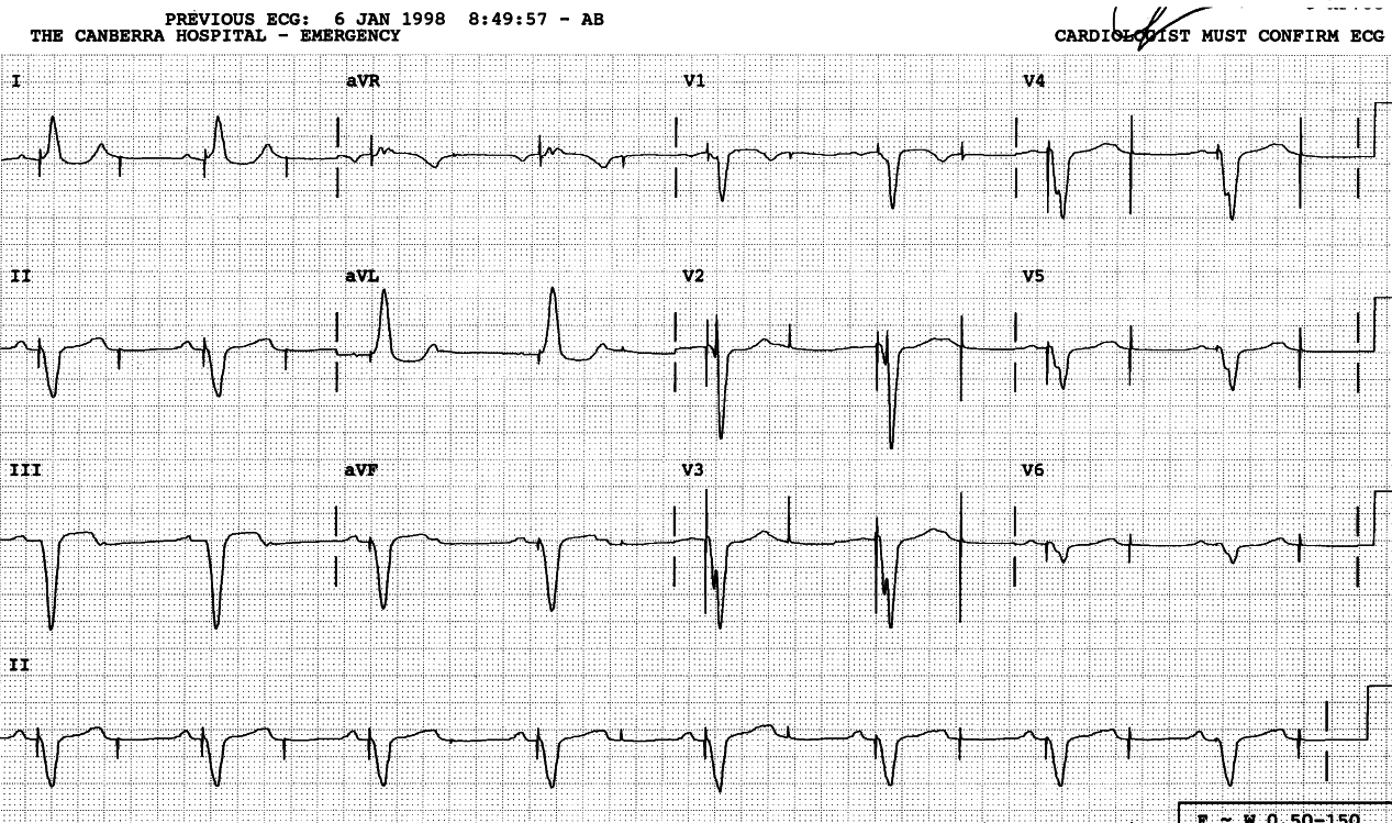 83 year old woman monitored in CCU, perhaps on account of
advanced age.