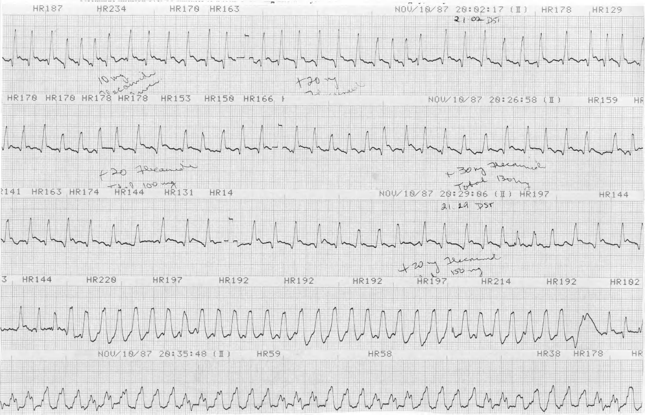 Flecainide infusion over 33 minutes to a total of 150 mg in a 58 year old man with ischaemic cardiomyopathy and arrhythmias. 