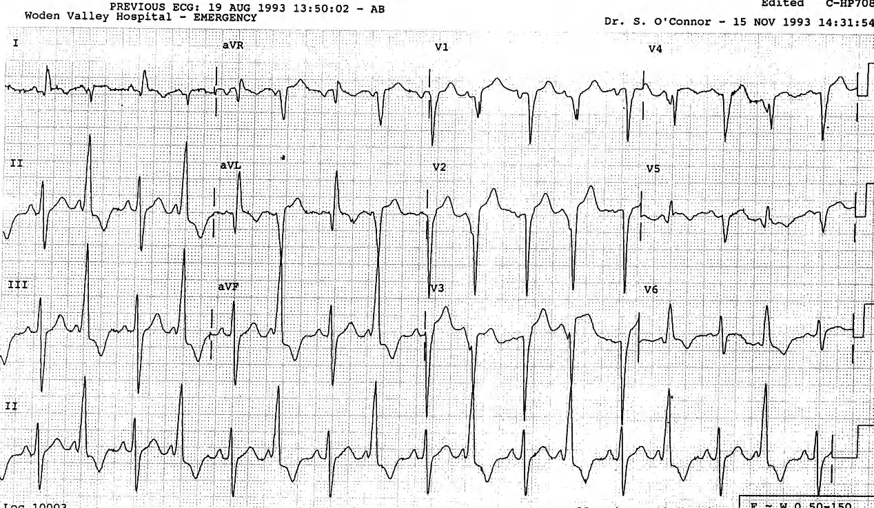 Same ectopic morphology, in bigeminy. 