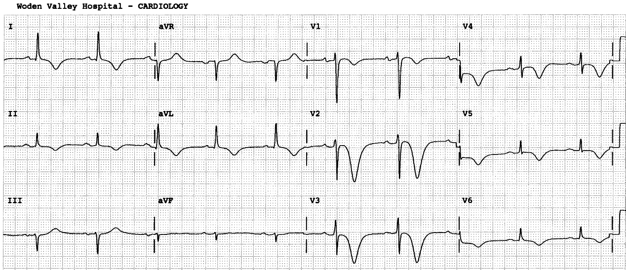 Recurrent inversion