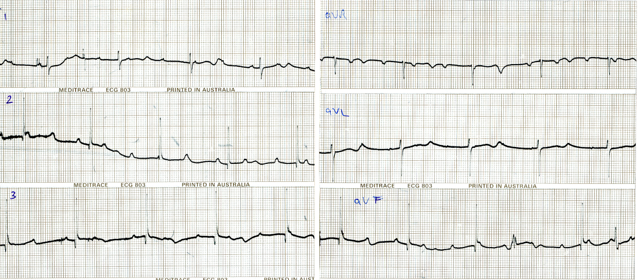 3 year old     girl with 8 months history of convulsive syncope. Limb     leads. 