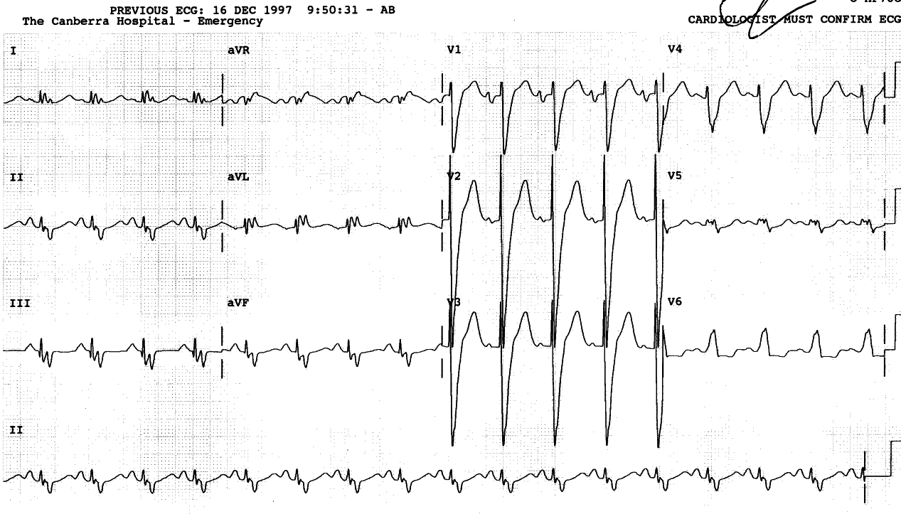 The right precordial R waves look like antennÃ¦.