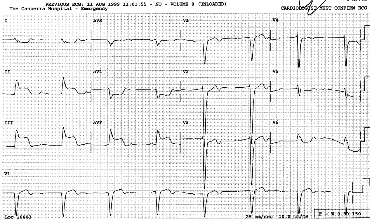 59 year old man in pulmonary Ådema.