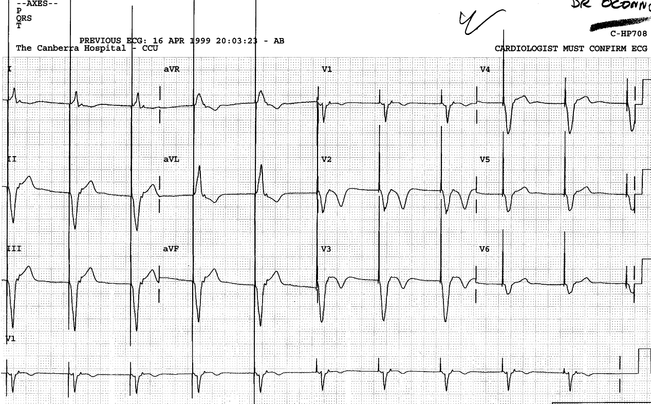 73 year old lady in CCU for unstable angina. She had a
permanent pacemaker implanted 3 years previously for intermittent atrial
fibrillation and syncope. Angiography showed normal left ventricular
function with small antero-apical hypokinesia and a 95% LAD lesion
suitable for angioplasty.
