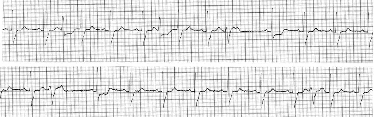 50 year old man performing a poor manâs exercise test while lying in his CCU bed (Standard Lead 1). 