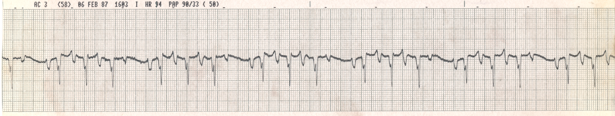 Wenckebach trigeminy due to 4:3 conduction of sinus tachycardia.