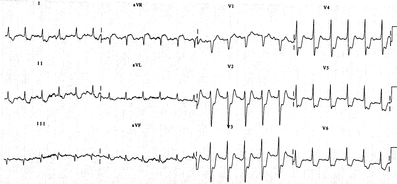 61 year old man with history of exertional angina, prostrate after radical prostatectomy.