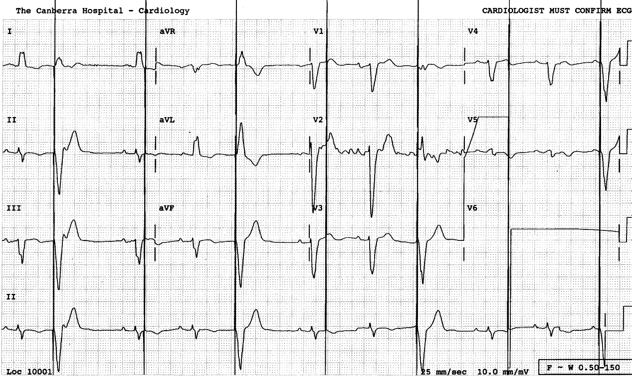 86 year old lady with episodes of pre-syncope. Her pacemaker had
been slowed down delibaretely. Why?