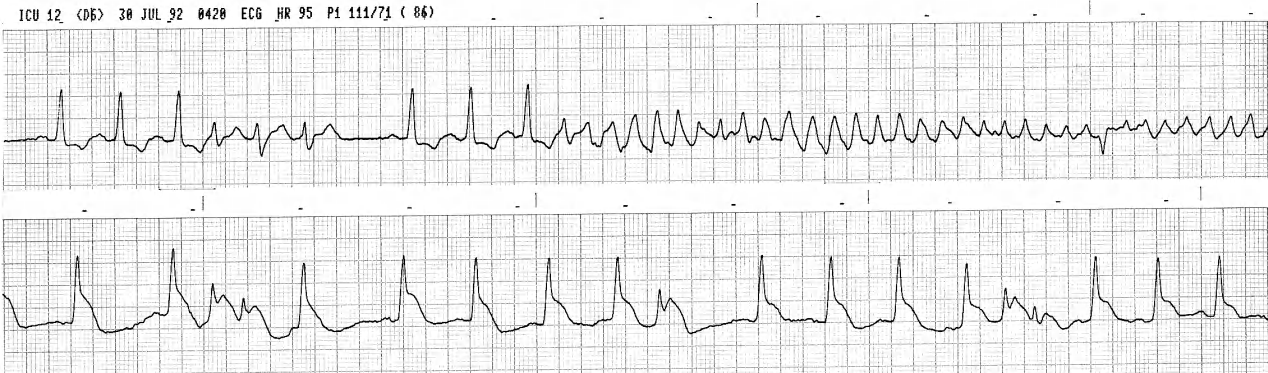 A later, similar episode of VF. Small complexes are VEBs; one of them starts the VF in both tracings. 