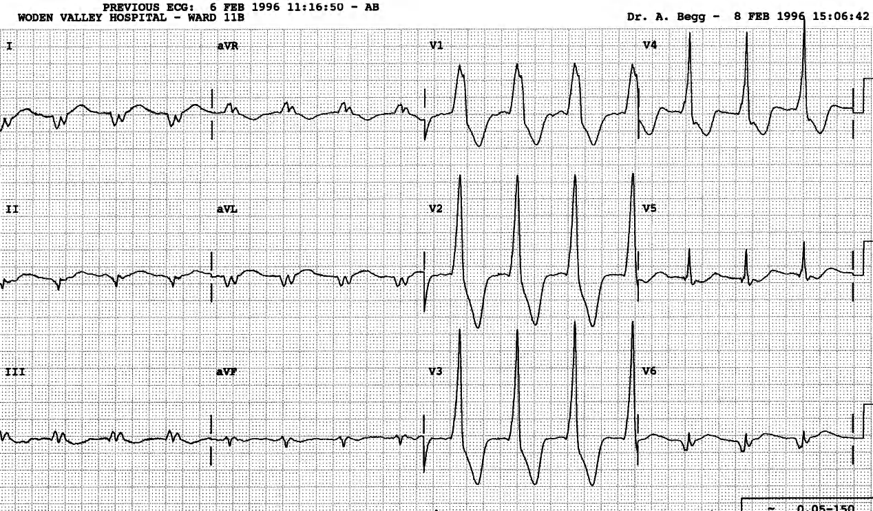 90 year old man in Geriatric Ward with known chronic atrial fibrillation. 