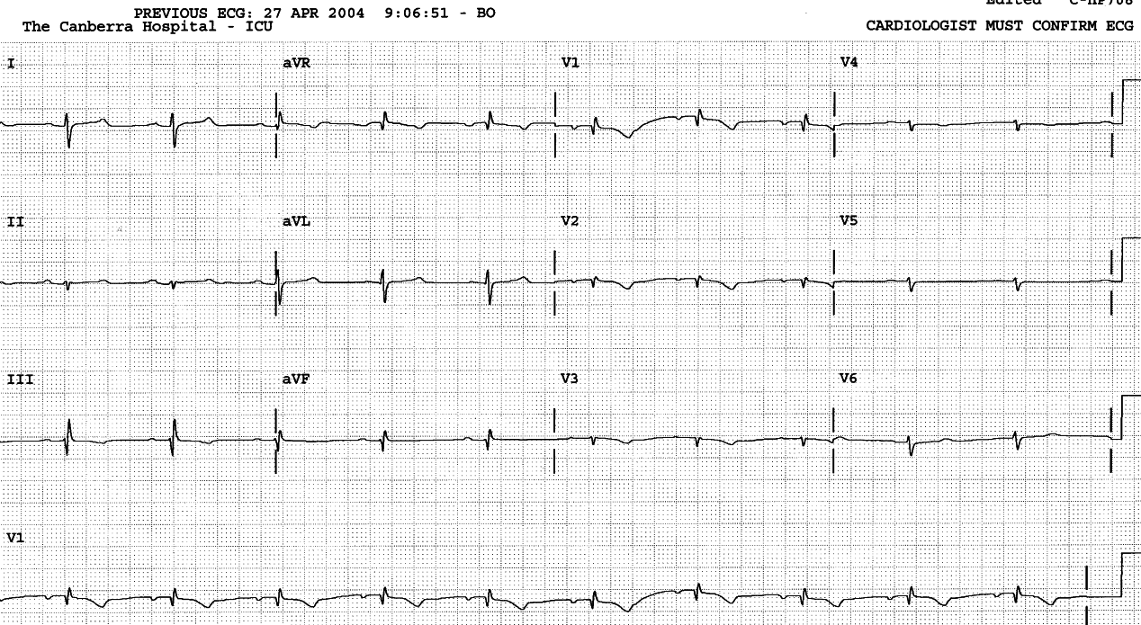 49 year old lady following a left pneumonectomy